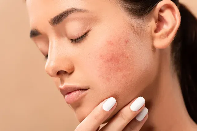 Acne Care